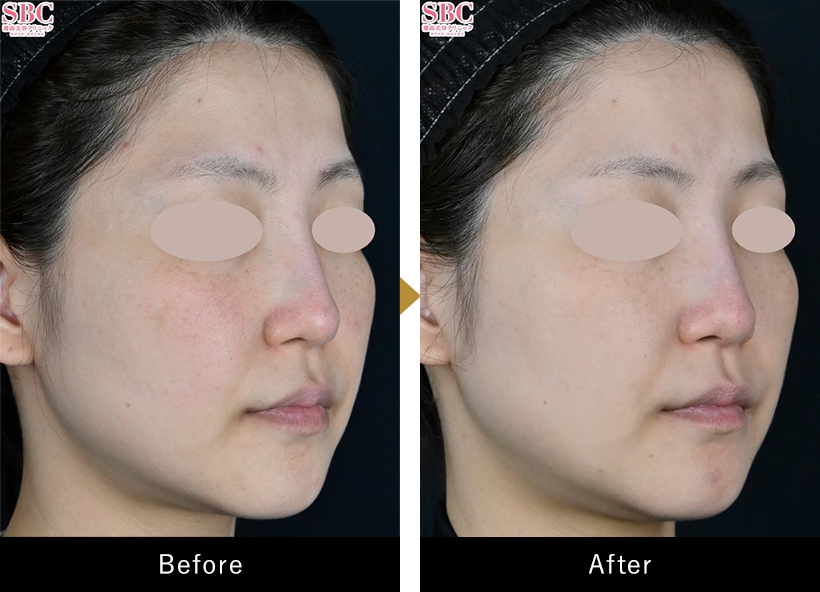 acne before after case photo