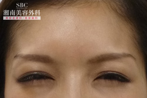 botox after case photo