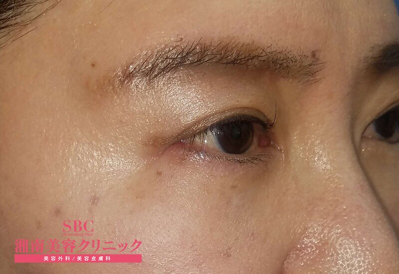 eyebrow after case photo