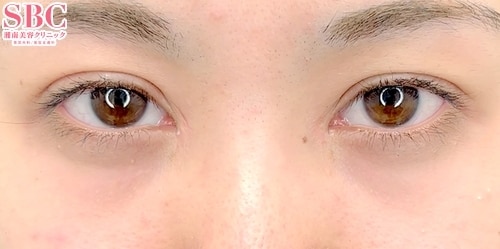 eyes after case photo