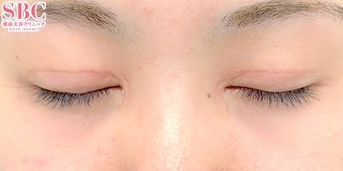 eyes after case photo