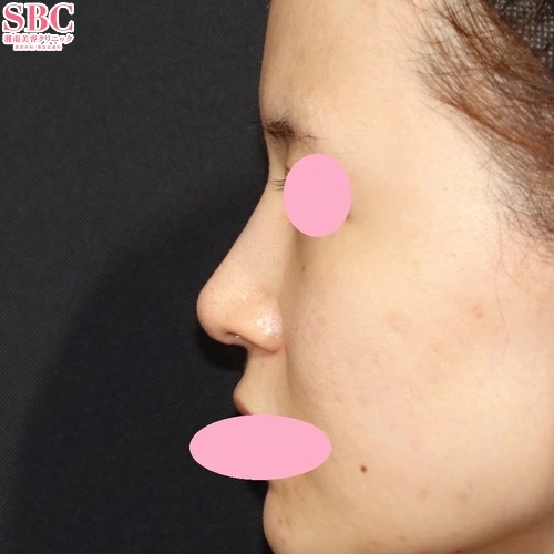nose after case photo